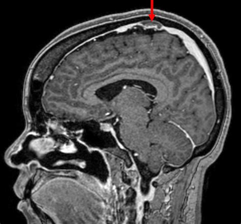 Postdural puncture headache and cerebral venous thrombosis in obstetric ...