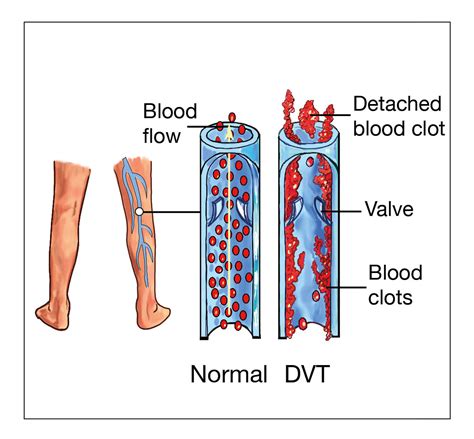 Deep vein thrombosis (DVT)