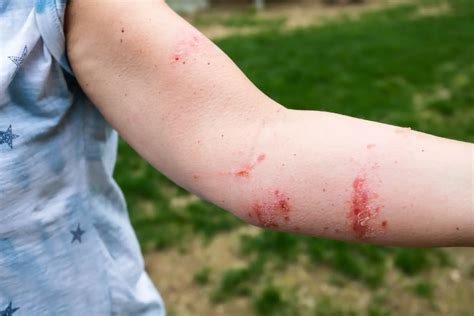 Rashes Treatment in Northbrook, IL | Eczema | Poison Ivy