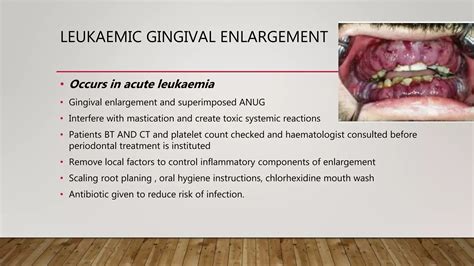 Treatment of gingival enlargement | PPTX