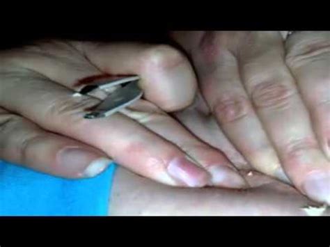 Image result for Exploding Zit Videos 2013