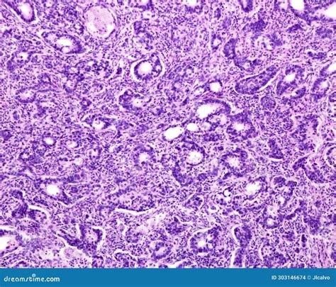 Human Prostate Cancer. Adenocarcinoma Stock Photo - Image of microscope, light: 303146674
