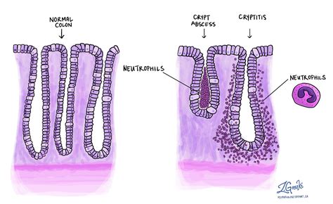 Kriptitis | Moje poročilo o patologiji