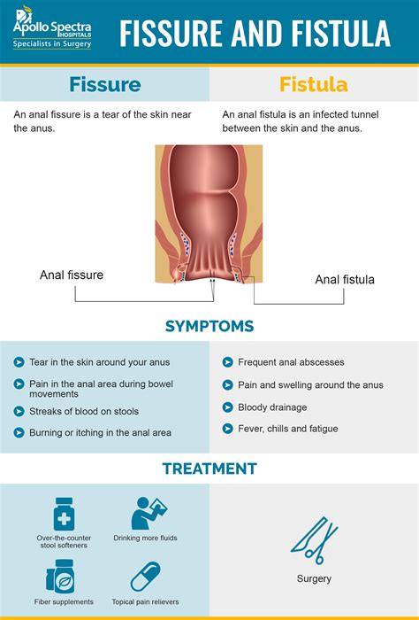 Perineal Fistula Symptoms