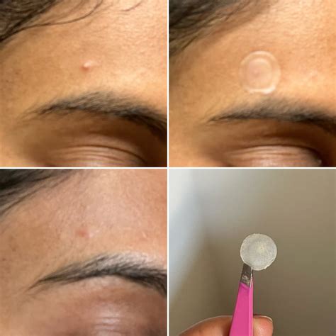 Scientists Just Discovered a Pimple Patch That May Work Better Than Most Acne Creams