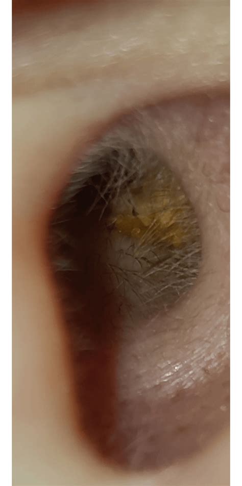 My bf won't let me dig it out 😭 : r/earwax