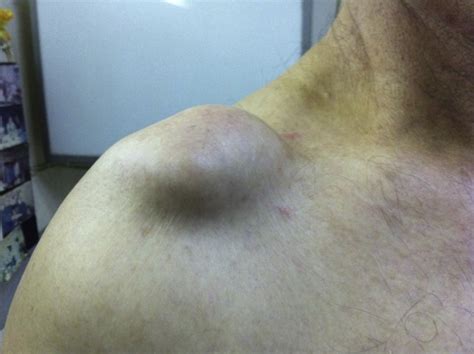 Gigantic acromioclavicular joint cyst: presentation and mini review - Journal of Shoulder and ...