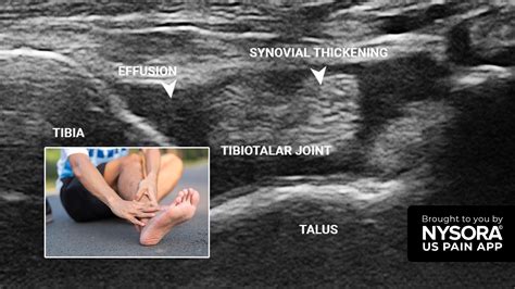 Joint Effusion Treatment Knee Effusion Synovitis Volume Measurement