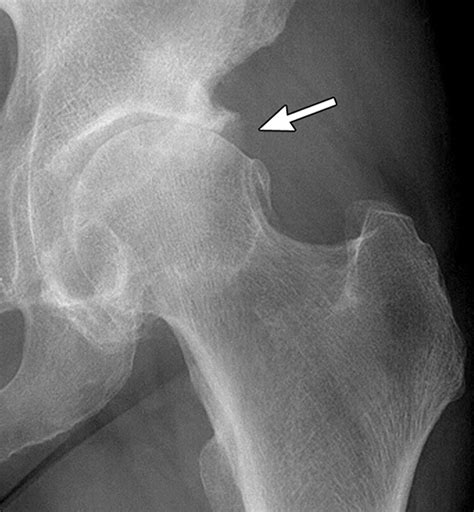 Normal hip joint xray - questwings