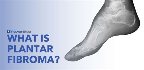 Fibroma Foot Surgery