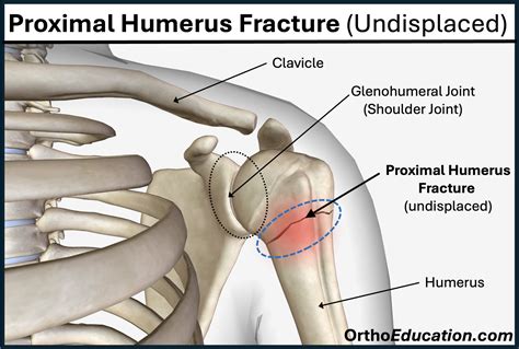 Proximal Humerus Fractures - Shoulder Education