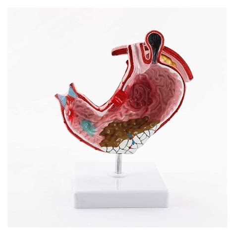 Buy JKFZD Research Model Anatomy Stomach, model of tritis model of tric ...