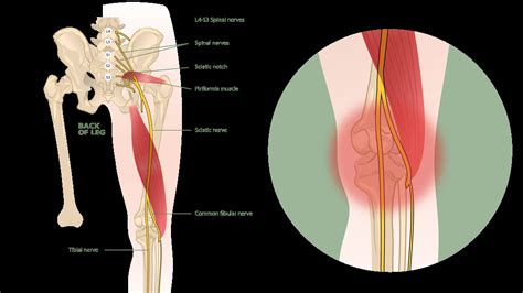Can Sciatica Cause Knee Pain? - Dr. Eric Giang