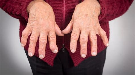 Rheumatoid Arthritis Vs Osteoarthritis - Prof Dr. Robert Hierner