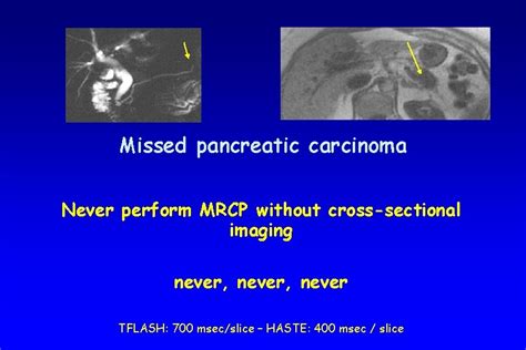 Image result for Abnormal MRCP