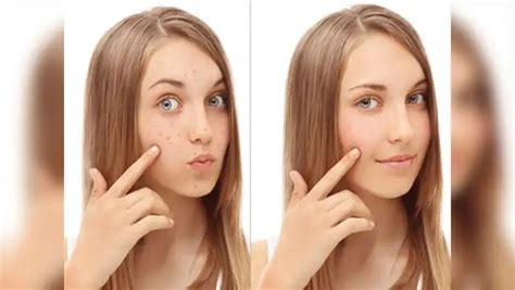 How To Remove Acne Scars By Using Turmeric,முகப்பரு வடுக்களை போக்கும் ...