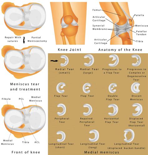 Meniscal Tear - Have You Torn Your Meniscus? - Injury Health Blog