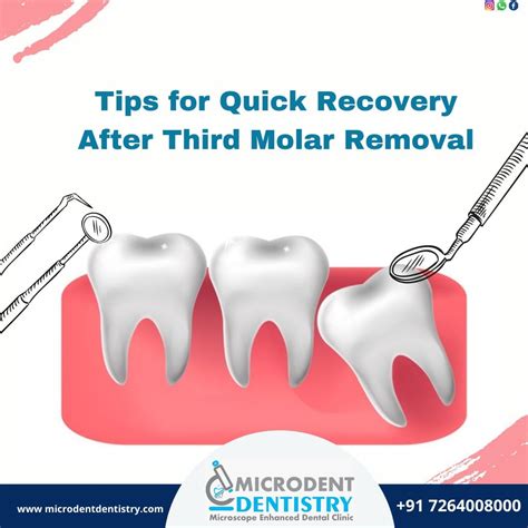Tips for Quick Recovery After Third Molar Removal | by Microdent Dentistry | Medium