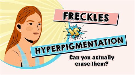 Freckles vs Hyperpigmentation
