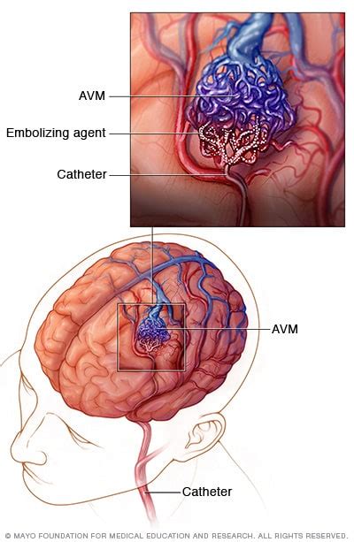 Avm Brain Surgery Risks - mapasgmaes