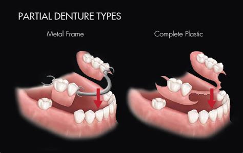 Image result for Bottom Front Teeth Partials