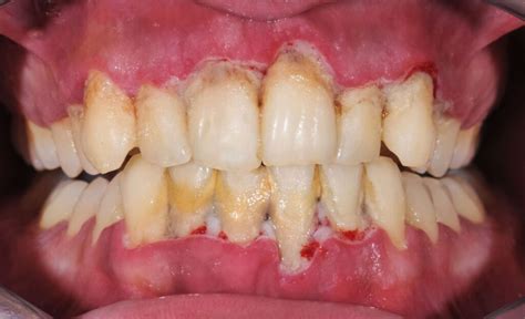Image result for Bottom Teeth Calcium Buildup