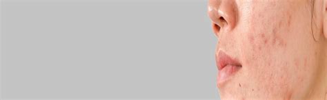 Acne Scar Reduction | Acne Scar Treatment in Bangalore
