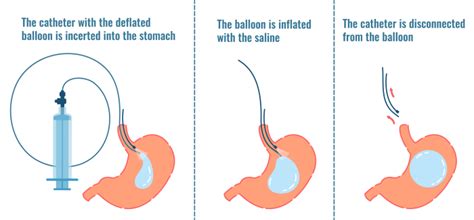 How the Intragastric Balloon Works to Control Appetite