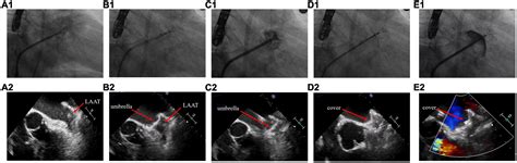 Frontiers | Percutaneous left atrial appendage closure using the LAmbre ...