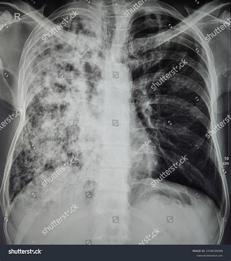 Miliary Tuberculosis X Ray A Case Report On Miliary Tuberculosis In