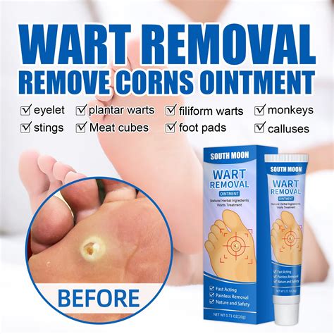 Buy Fast-Acting Wart Remover - Plantar and Genital Wart Treatment, Attacks Warts On Contact ...