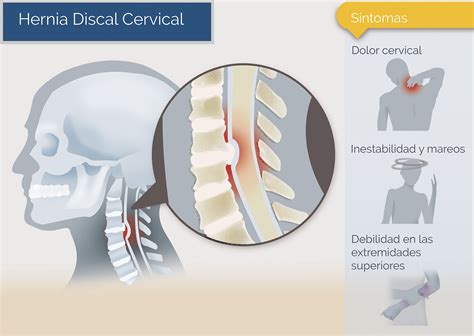 Hernia discal Cervical - Patología Neurológica - Neurocirugía de la Torre