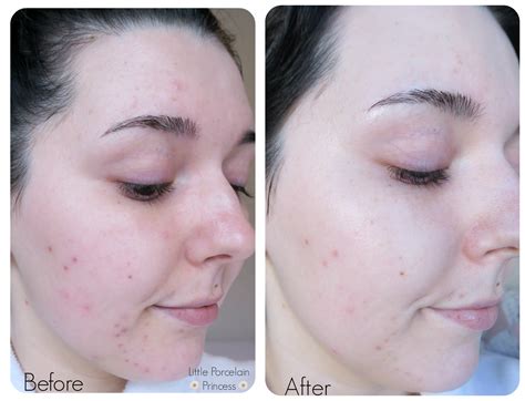 Azelaic Acid Before And After