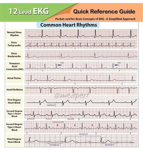 Ekg ecg simple nursing heart sounds 5 ekg lead placement heart sounds aortic nd studocu – Artofit
