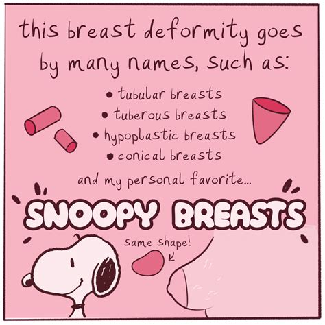 Hypoplastic Tubular Breast