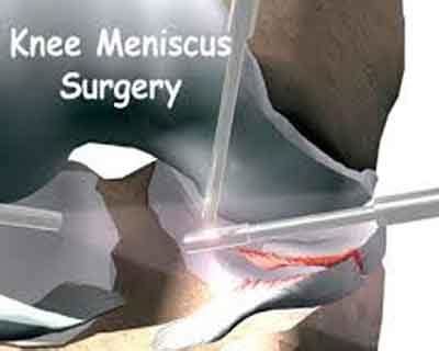 Intraoperative Platelet-rich plasma reduces meniscus repair failure ...