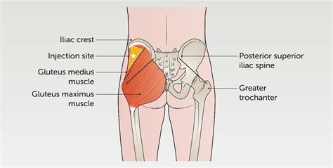 Image result for Injection Sites