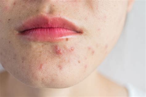 Why do I get spots around my mouth? - dr. Anton dermatologist