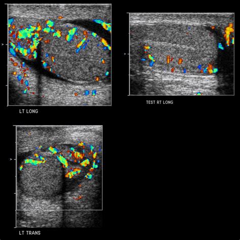 School ager with left testicular pain and swelling | Pediatric Radiology Case | Pediatric ...