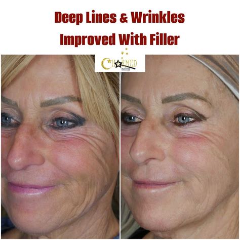 Rejuvenate Your Look: Exploring Fillers for Deep Lines and Wrinkles in the Cheeks and Lower Face ...