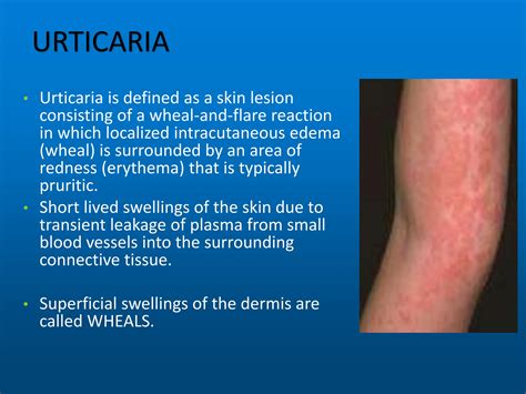 urticaria skin disease dermatology ppt.pptx