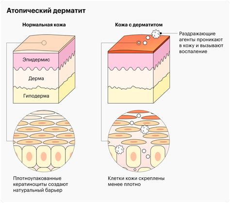Атопический дерматит у детей: лечение, причины, симптомы, факторы риска