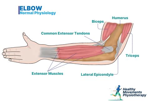Dry Needling and Tennis Elbow: Does It Really Work - Healthy Movements Physiotherapy