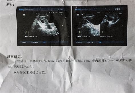 怀孕8周不见胎心，多半是这3个原因，孕妈不妨再等等