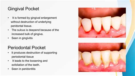 Periodontal pocket , Gingival Recession , Tooth mobility | PPTX