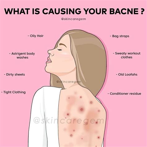 heres what is causing your bacne | Skin care routine, Skin care tips, Bacne