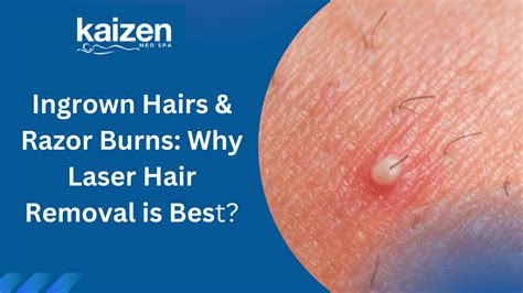 Goodbye to Ingrown Hairs: Benefits of Laser Hair Removal