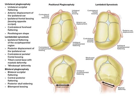 Craniosynostosis | ACNR Journal