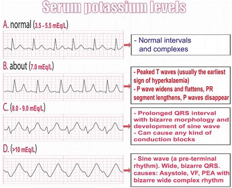 Hyperkalemia causes, signs, symptoms, ECG changes and treatment