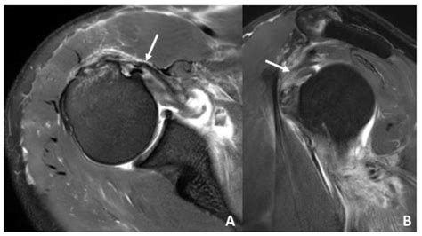 Mri Shoulder Dislocation
